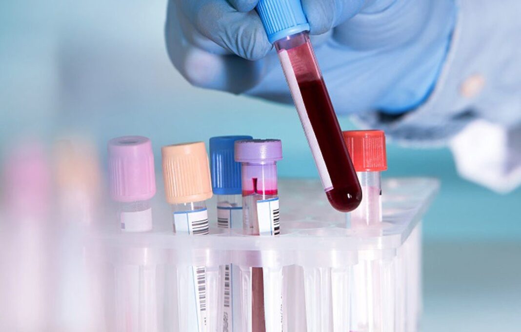 Un test sangvin poate prezice probabilitatea de deces la pacienții COVID-19