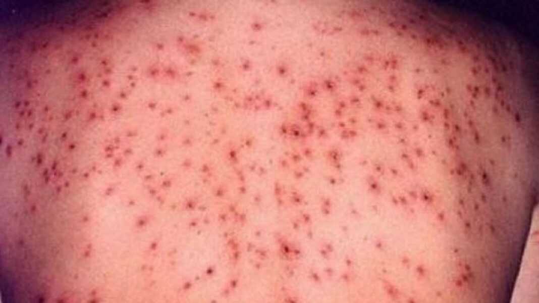 Efectele devastatoare ale rujeolei, explicate de specialiști. Tot mai mulți părinți refuză să-și vaccineze copiii
