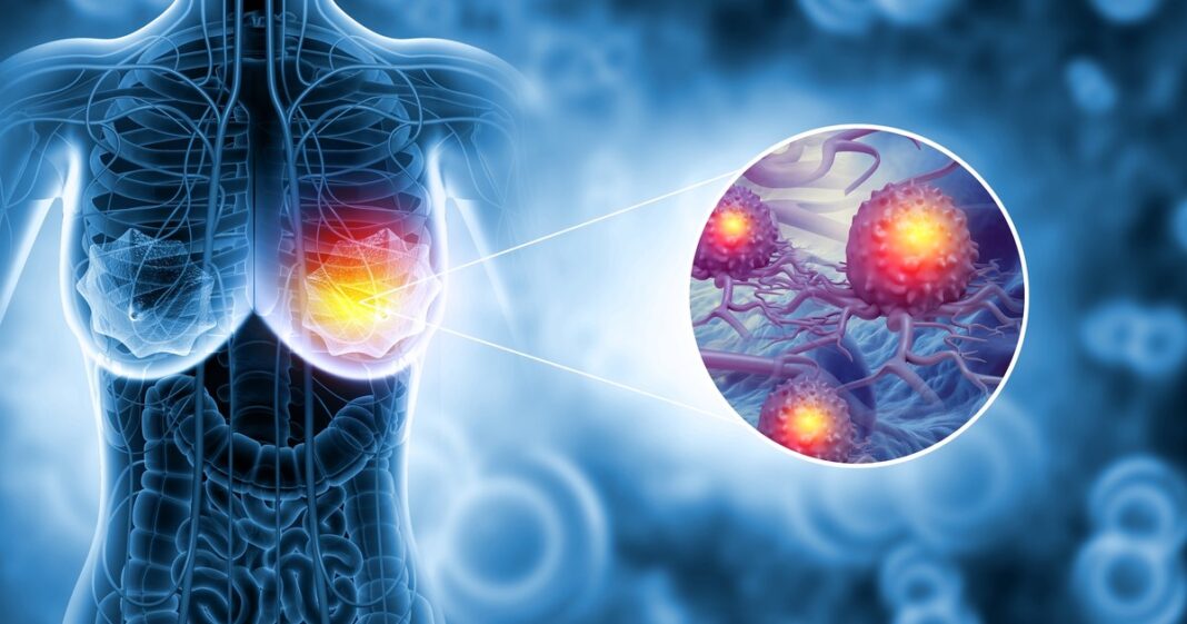 Medic senolog, despre cât de mult contează prevenția și genetica în cancerul la sân. „Mamografia: două minute care pot salva o viață“