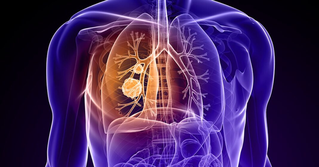Descoperire revoluționară: un test de sânge ar putea depista cancerul pulmonar